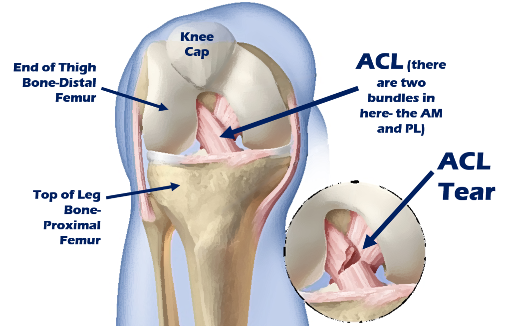 ACL Surgeon in india